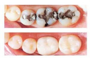 Dental Fillings - Restorative Dental Treatment in Wilmington, DE