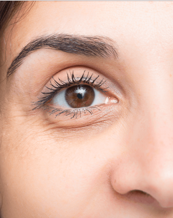 Under eye bags, hollowing, dark circles and discolouration