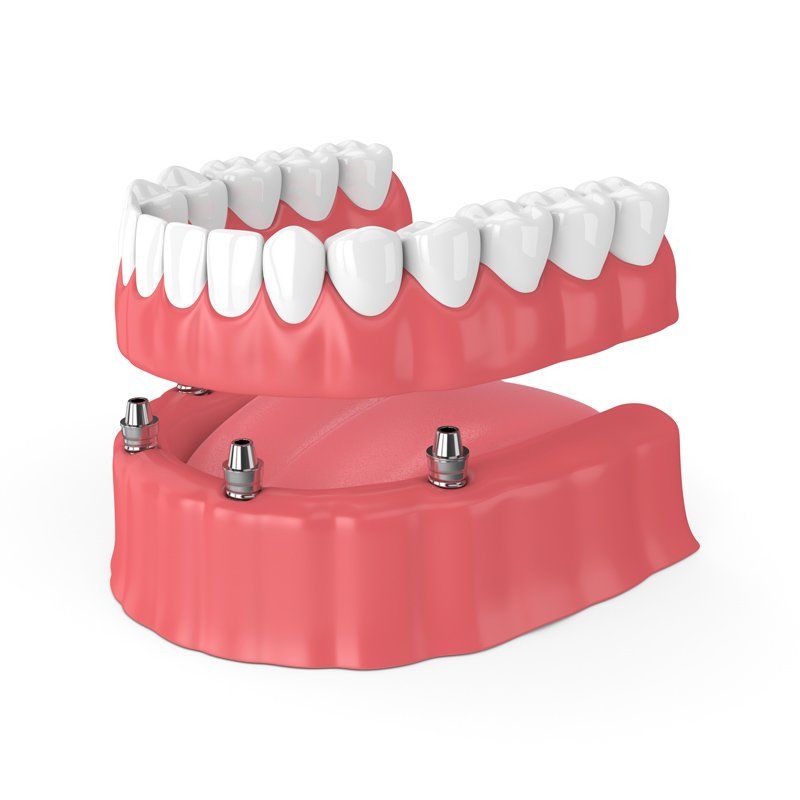 Dental Team — Implant Denture in Albuquerque, NM