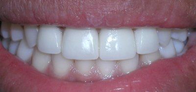 Albuquerque Dental Office — Tooth with Veneers in Albuquerque, NM