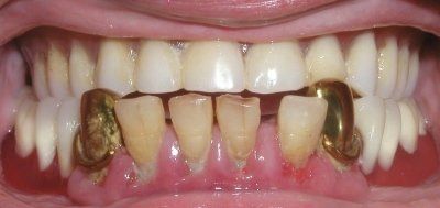 Fractured Tooth — Albuquerque, NM — Comfortable Dentistry 4U