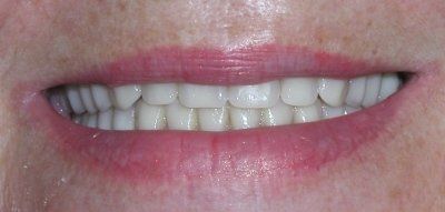 Implant Supported Dentures — Albuquerque, NM — Comfortable Dentistry 4U