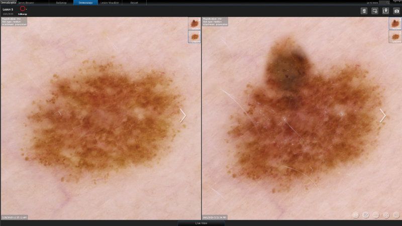 Zwei Hautmuttermale, nebeneinander zum hochauflösenden Vergleich.