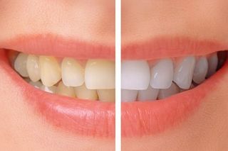 Before and After Dental - Dr. Jack Bernardo Jr. in Montgomery WV