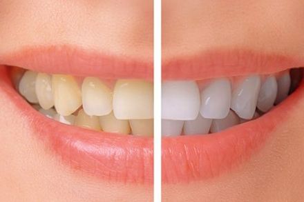 Before and After Dental - Dr. Jack Bernardo Jr. in Montgomery WV