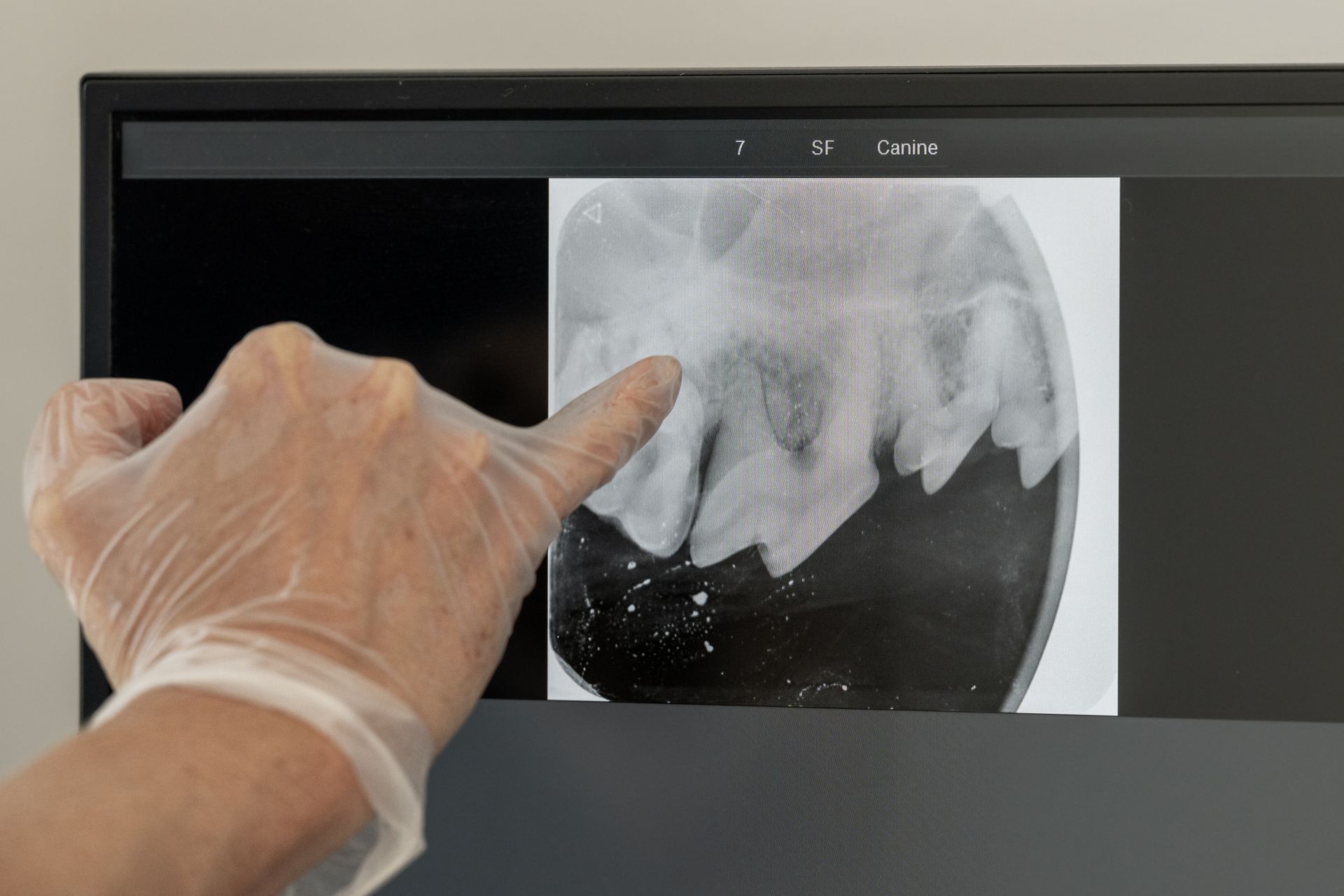 A person wearing gloves is pointing at an x-ray on a computer screen.