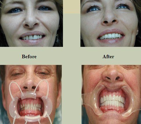 Dental Phobia Dentists — Customer's Before and After Picture in Marietta, GA