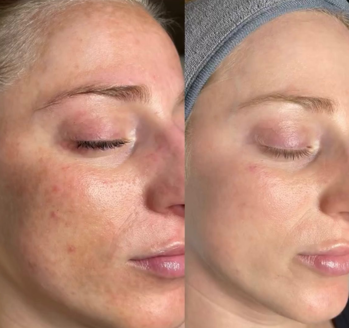 ReveSkin Enlighten Depigmentation System pigmentation even skin tone before and after