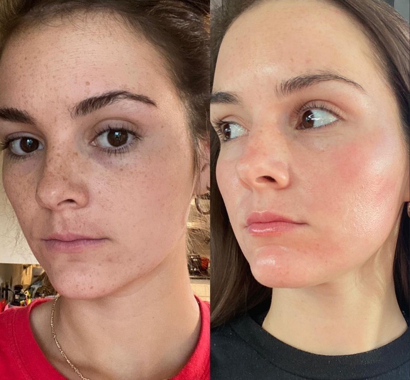 Reveskin Revepeel smooth, reduced hyperpigmentation before and after