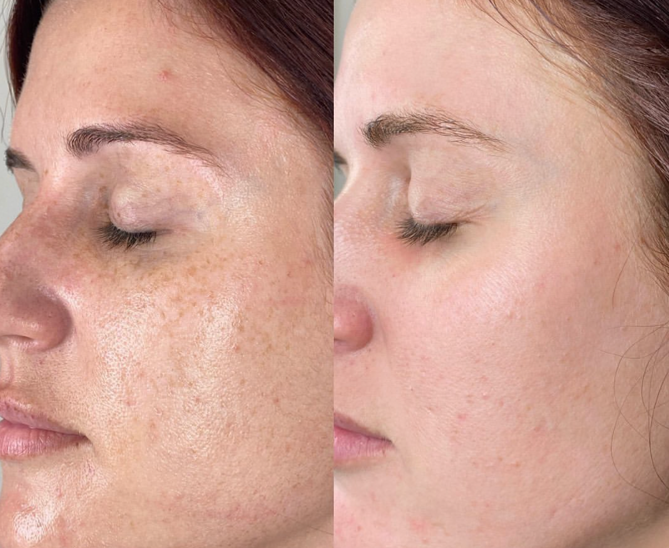 Reveskin Revepeel even skin tone reduce melasma, age spots and sun damage before and after
