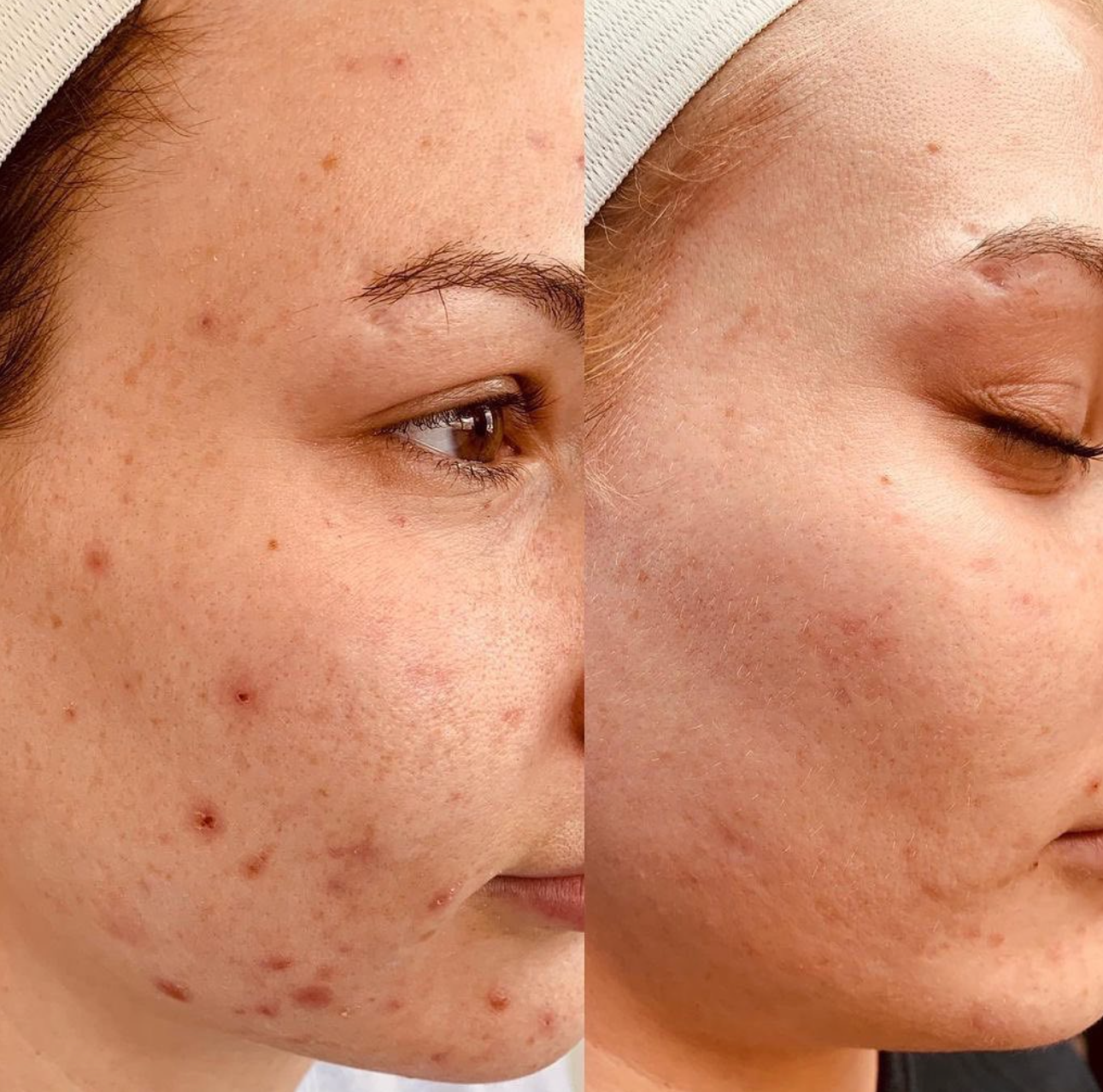RevePeel Fresh Peel improve skin tone, acne marks, clear skin