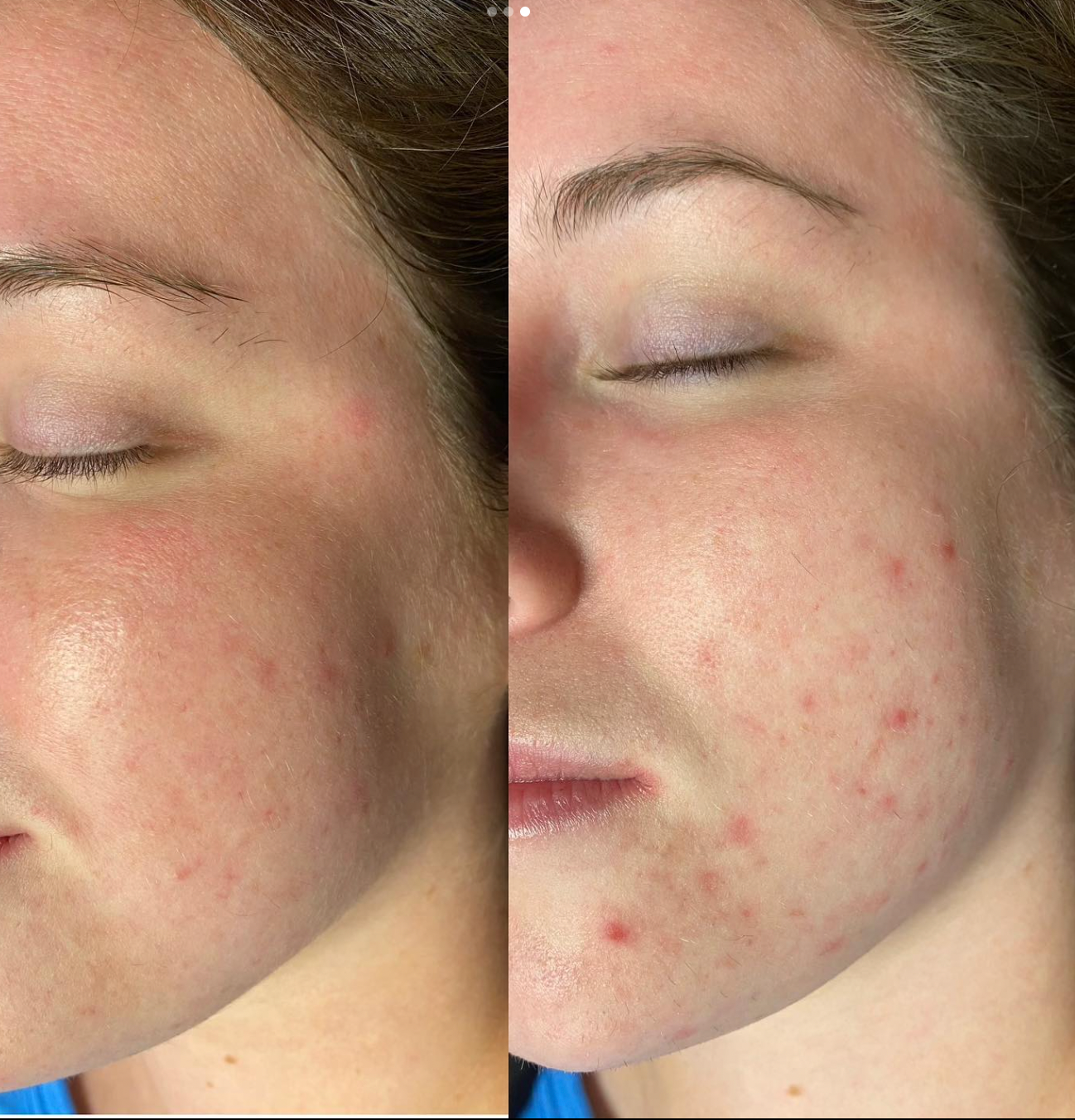 Skinbetter Science Alpharet Profession Peel System before and after clear acne