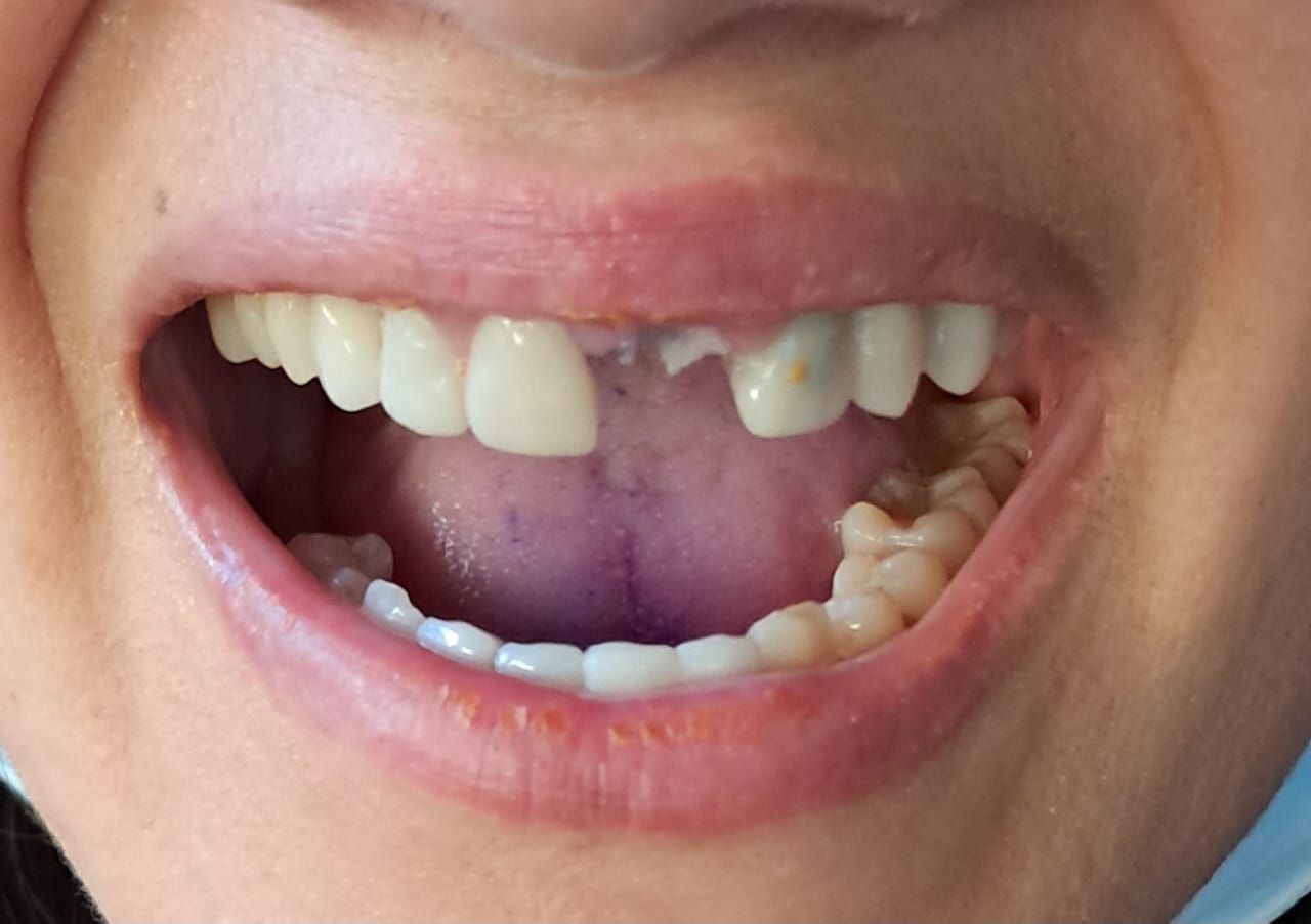 Primer plano de una boca sonriente que muestra dientes y encías manchadas.