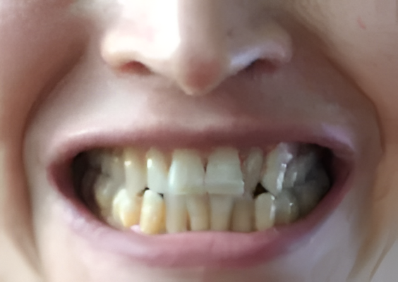 Primer plano de una boca sonriente que muestra dientes y encías manchadas.