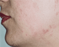 acne dopo il trattamento di cura presso il centro in provincia di Varese
