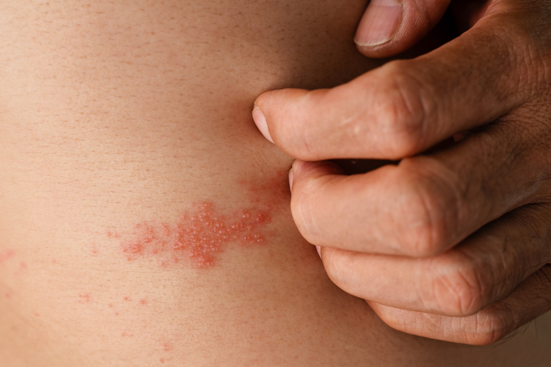 Person scratching an itchy red rash on their abdomen.