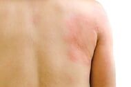 Mans Back - Allergy Physicians in Yarmouth Port, MA