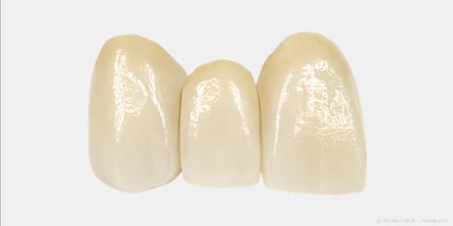 Zahnbrücke aus Keramik für die oberen Schneidezähne