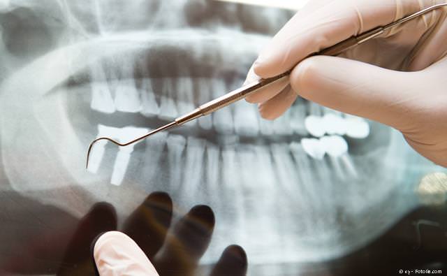 Implantate zum Ersatz fehlender Backenzähne, die sonst nur durch eine Teilprothese ersetzt werden könnten Implantate zum Ersatz fehlender Backenzähne, die sonst nur durch eine Teilprothese ersetzt werden könnten