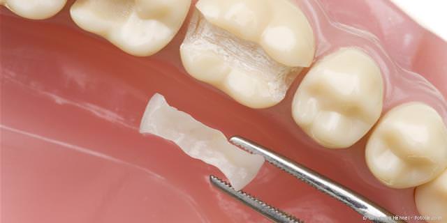 Cerec Keramik-Inlay