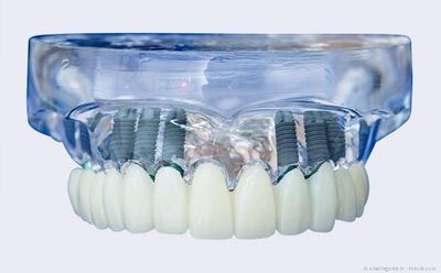 Mit Implantaten können statt herausnehmbarer Totalprothesen komplett festsitzende Zähne gemacht werden. Mit Implantaten können statt herausnehmbarer Totalprothesen komplett festsitzende Zähne gemacht werden.