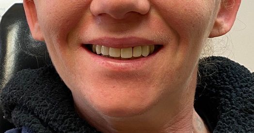 Close-up of a smiling person’s mouth and lower face, wearing a dark fleece collar