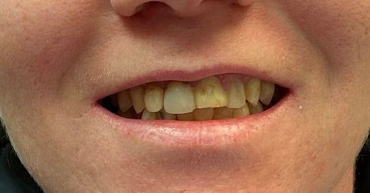 Close-up of a mouth with uneven yellow teeth and slightly parted lips