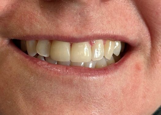 Close-up of a smiling mouth showing teeth with slightly yellowed enamel