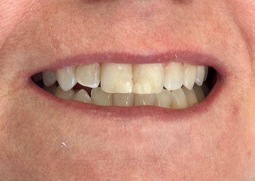 Close-up of a smiling mouth showing teeth with slightly uneven yellowed front teeth