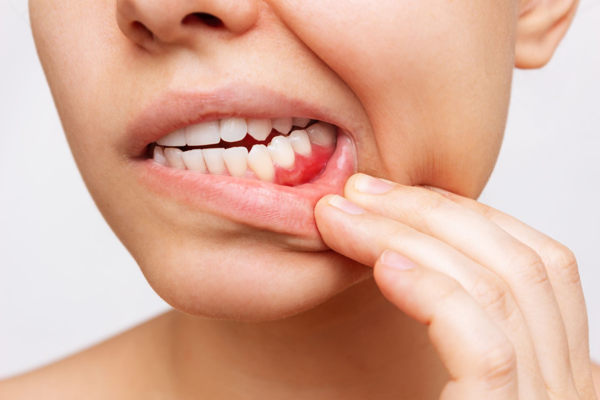 Irritated gums from periodontal disease