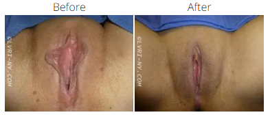 Comparison of a vulva before and after a medical procedure.