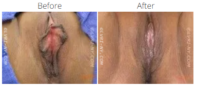 Comparison of before and after labiaplasty. The