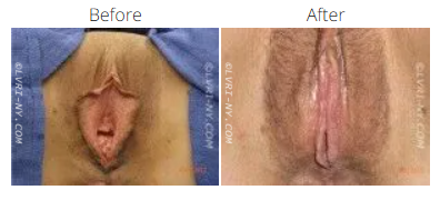 Comparison of labiaplasty results: before and after surgery.