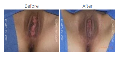 Before and after photos of a vulva. The “before” shows elongated labia, “after” shows it reduced.