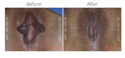 Comparison of a vulva before and after a medical procedure. Dark area reduced.
