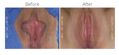 Before and after images of a labiaplasty. The