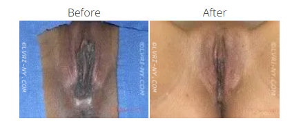 Comparison of vulva appearance before and after a medical procedure.