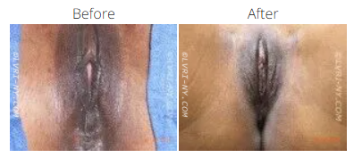 Comparison of vulva: before and after skin lightening treatment.
