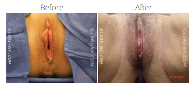 Comparison of vulva before and after surgery.