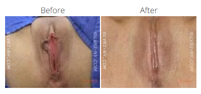 Before and after photos of a vulva. The 'before' photo shows more prominent labia, the 'after' photo shows a tightened appearance.