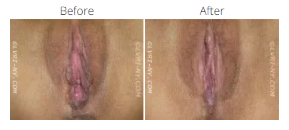 Side-by-side comparison of a vulva before and after a procedure. The