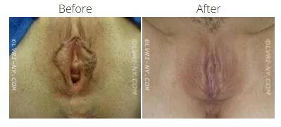 Comparison of vulva, before and after a cosmetic procedure.