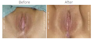 Before and after images of a vulva.