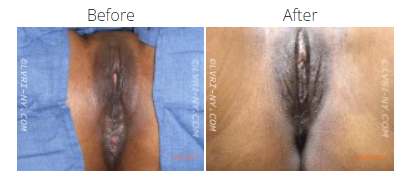 Comparison of a vulva before and after a procedure. The after image shows a lighter color.