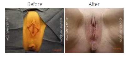 A before-and-after comparison of a vulva undergoing a surgical procedure.