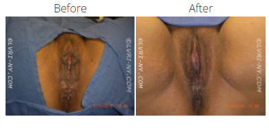 Before and after photos of a vulva. The