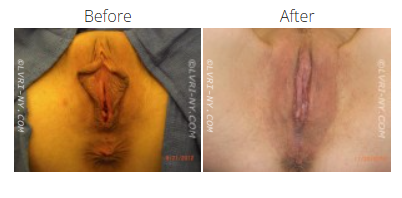 Comparison of a vulva before and after a surgical procedure, showing changes in appearance.