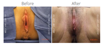 Comparison of a before and after view of a labiaplasty, showing the vulva. The before image shows elongated labia. The after image shows a trimmed labia.