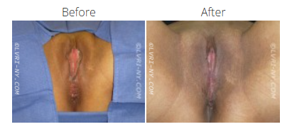 Comparison of a vulva before and after a procedure. The