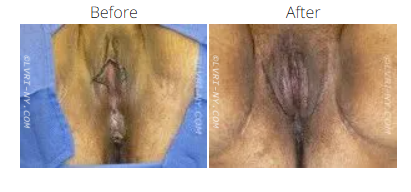 A medical comparison: before and after labiaplasty. The before shot shows sutures, the after shot healed tissue.